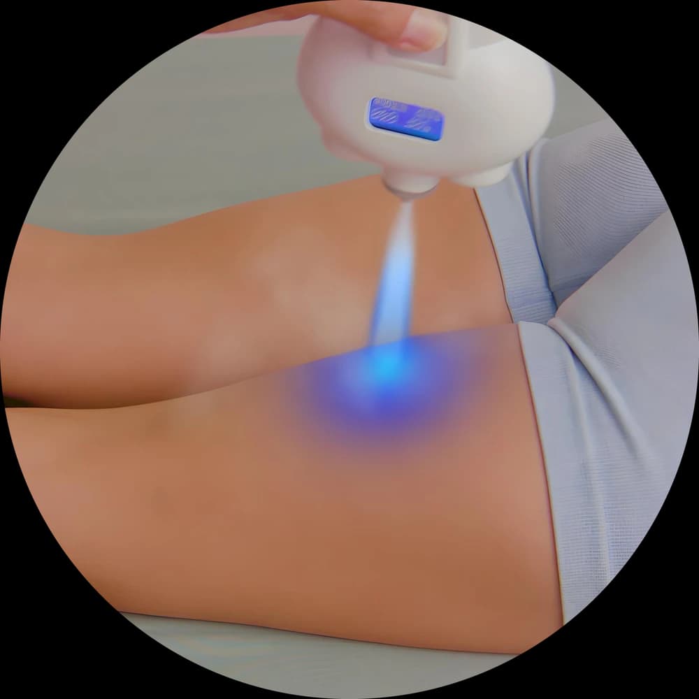 Localized Cryotherapy