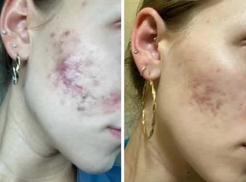 Clear Skin / Programa Virtual de Acné – 90 Días para Transformar Tu Piel