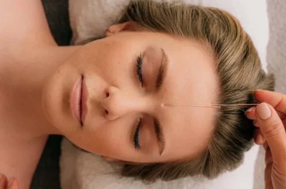 Acupuncture